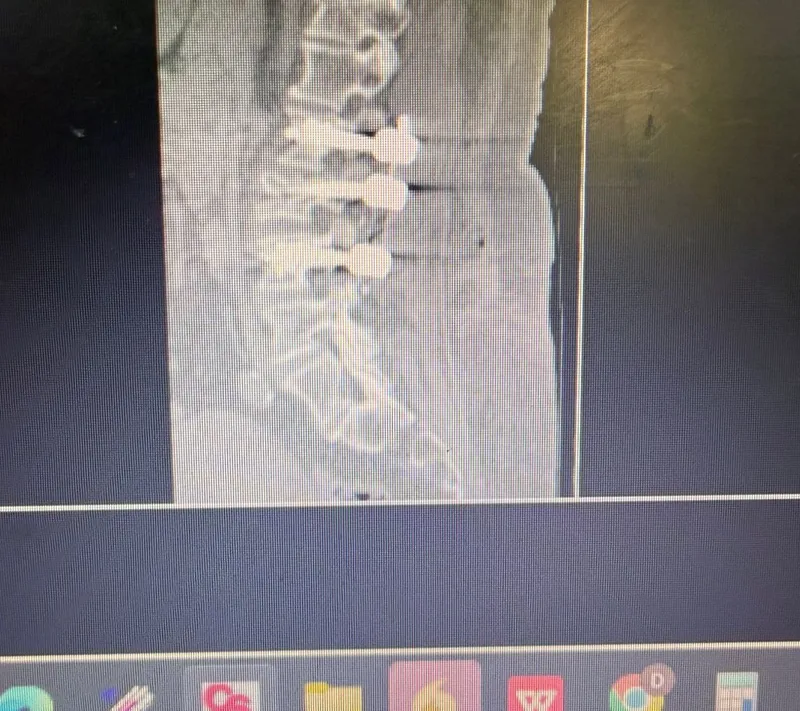 Tomografía de columna lumbar mostrando fractura vertebral