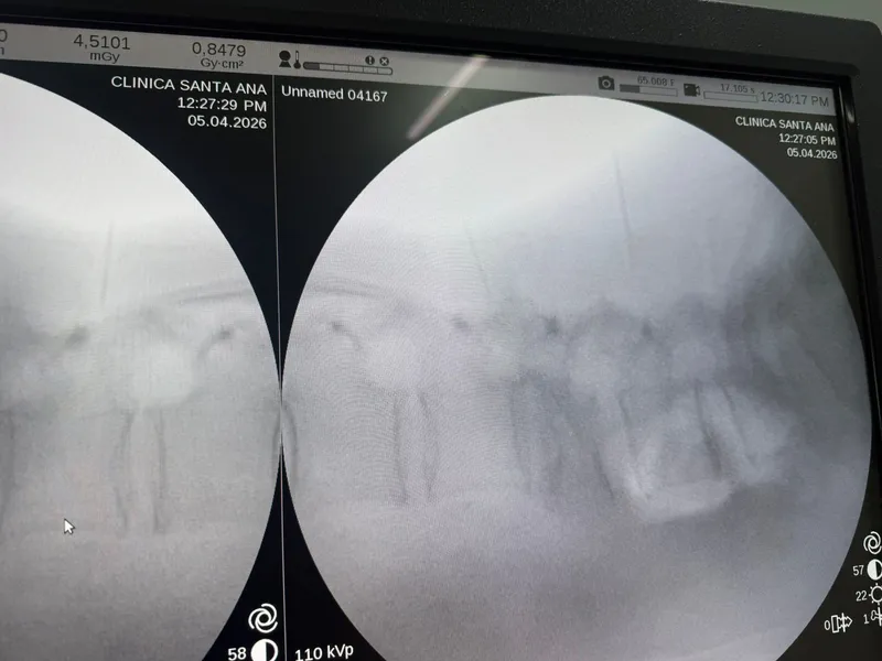 Fluoroscopia intraoperatoria mostrando tornillos pediculares cementados en posición correcta