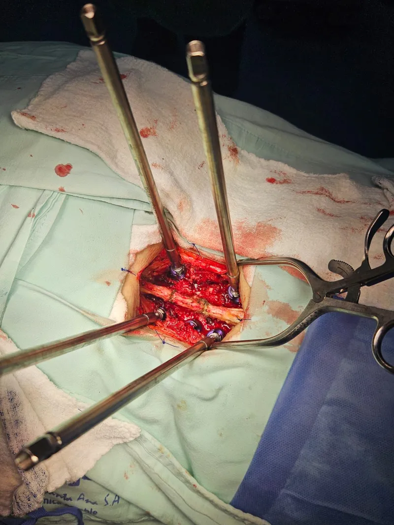 Vista intraoperatoria de tornillos pediculares cementados en columna lumbar
