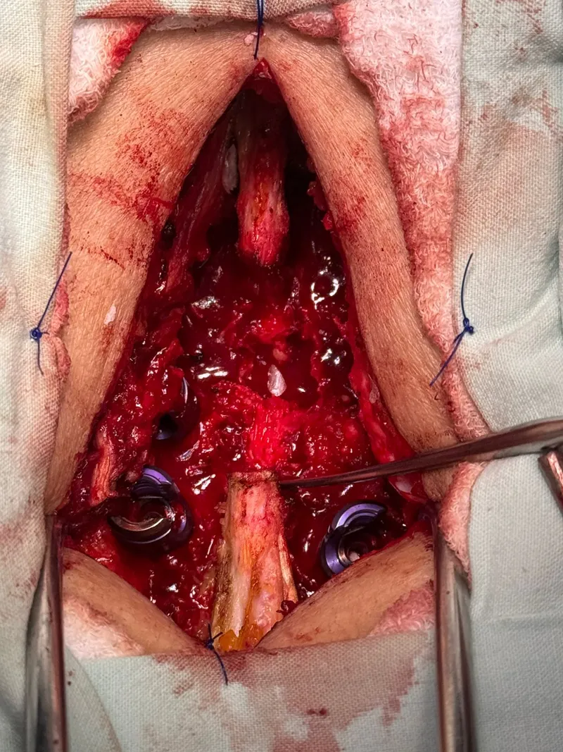 Campo quirúrgico durante artrodesis de columna lumbar con tornillos y barras