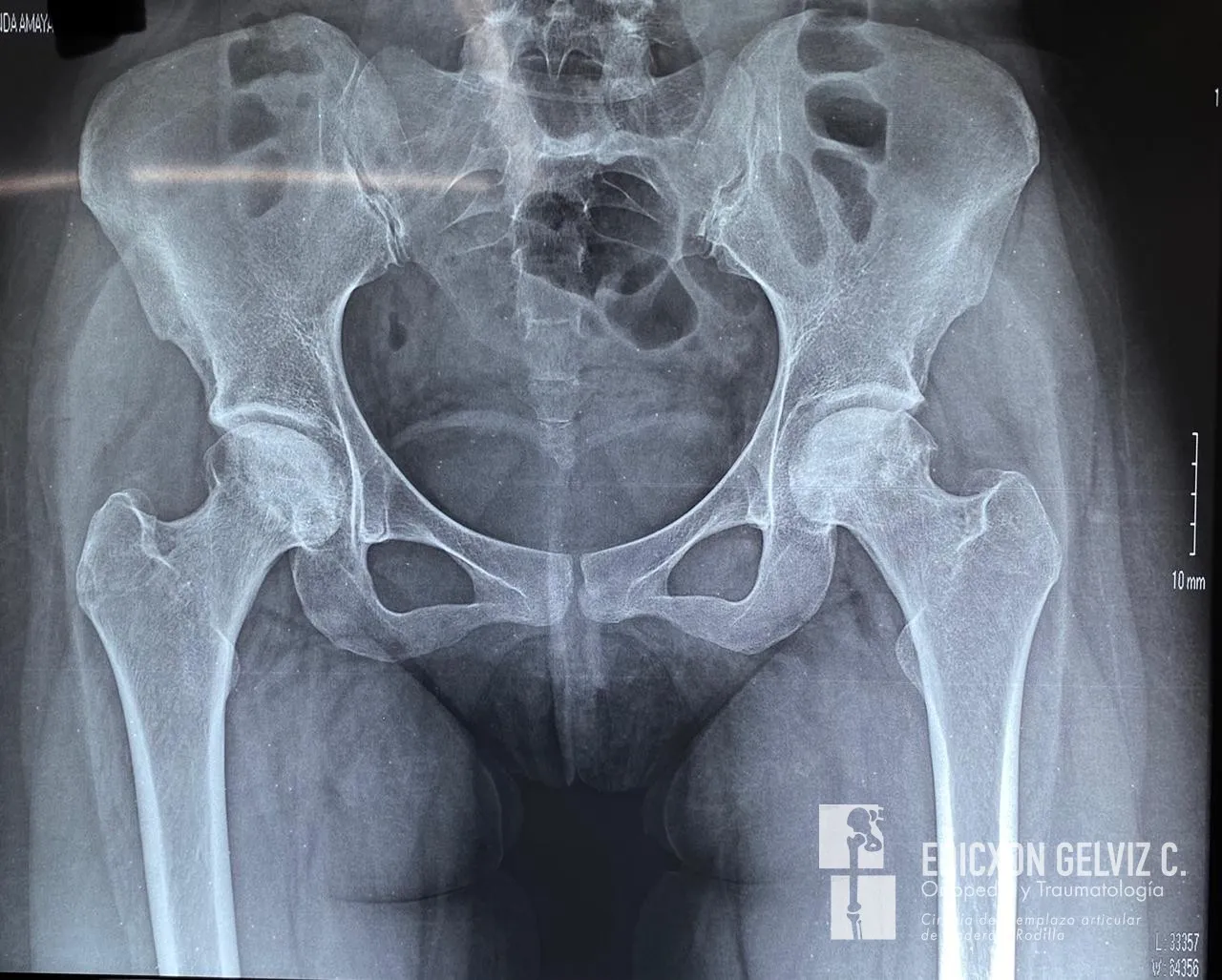 Radiografía preoperatoria de pelvis AP mostrando coxartrosis bilateral severa en paciente de 25 años