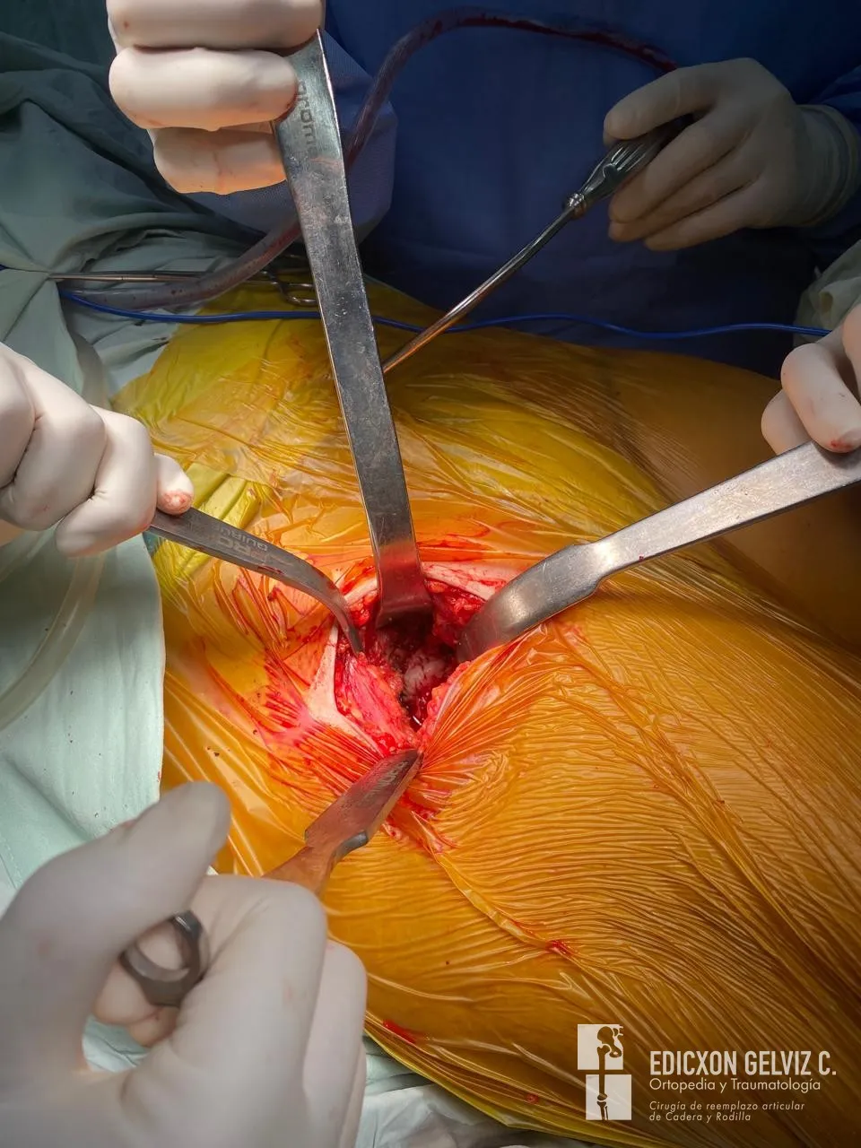 Vista intraoperatoria del abordaje anterior directo con retractores quirúrgicos