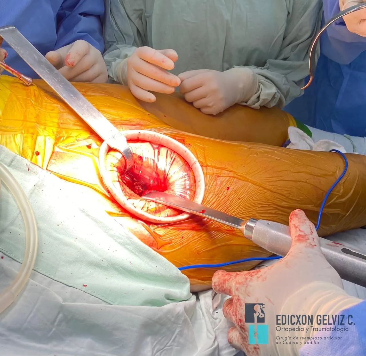 Preparación del acetábulo mediante fresado durante cirugía de reemplazo de cadera