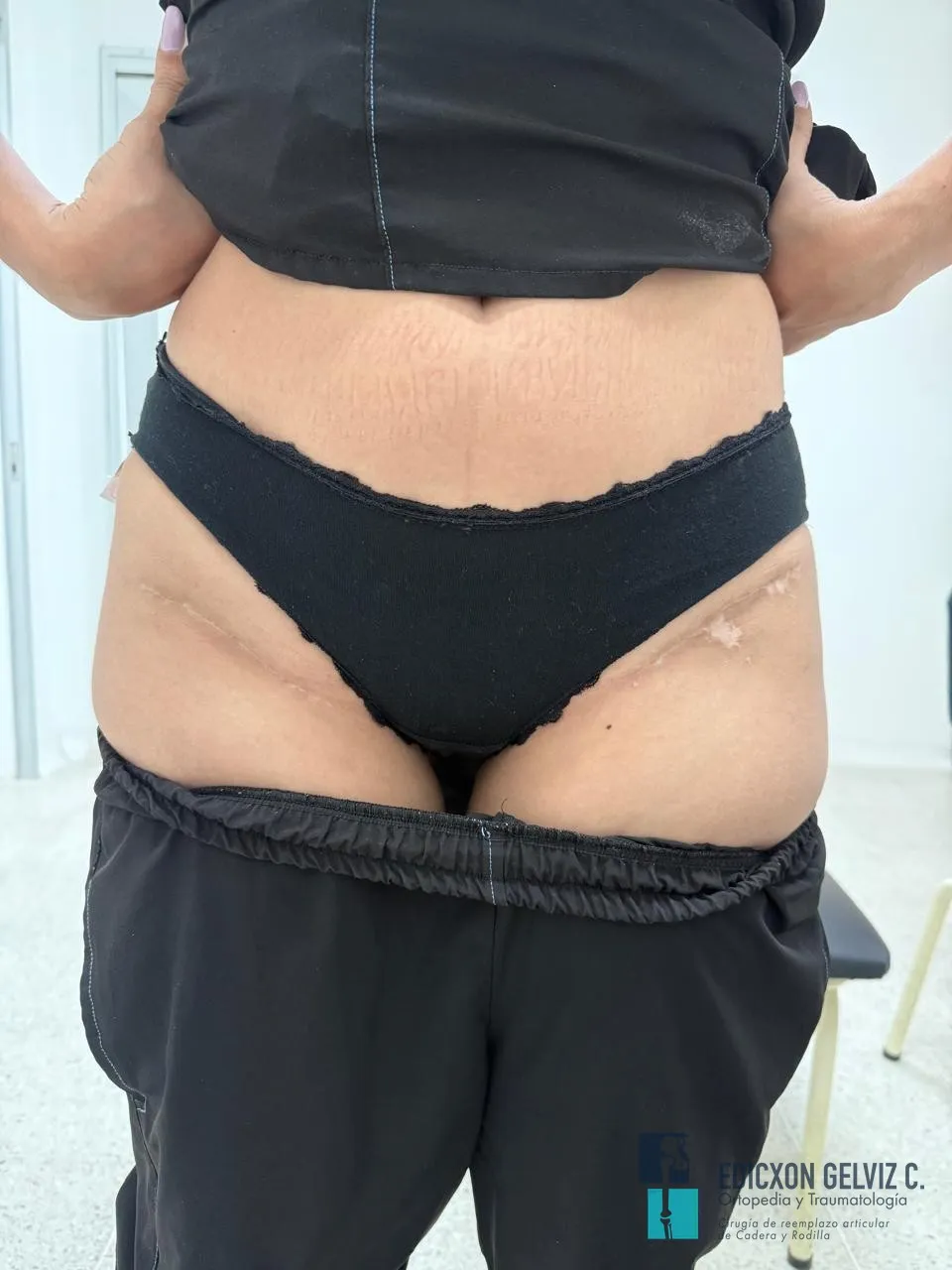 Seguimiento a 5 años mostrando cicatrices mínimas del abordaje anterior directo