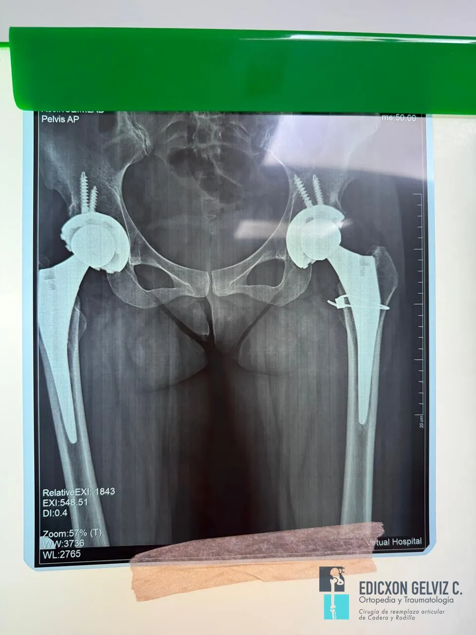 Radiografía de seguimiento a 5 años con prótesis bilateral de cadera en buen estado