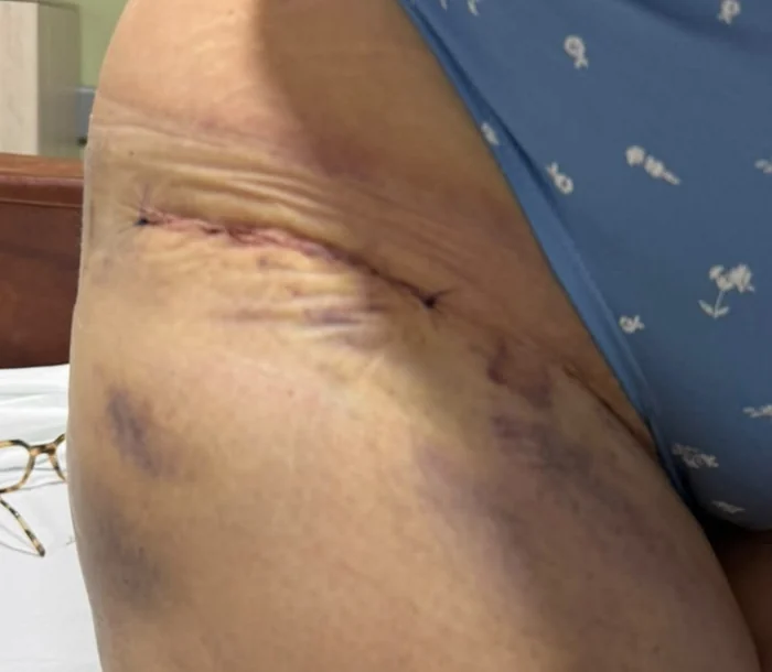 Cicatriz horizontal de reemplazo de cadera por abordaje anterior bikini durante el control posoperatorio