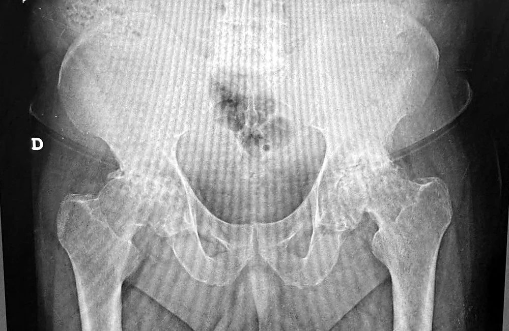 Radiografía de pelvis previa a la cirugía, con las dos caderas comprometidas