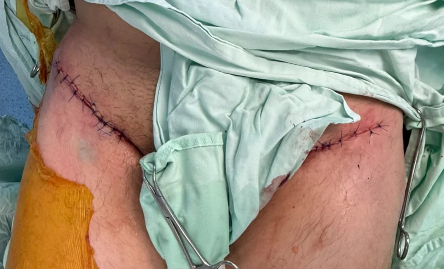 Las dos incisiones del abordaje anterior bikini ya suturadas al terminar la cirugía de reemplazo bilateral de cadera