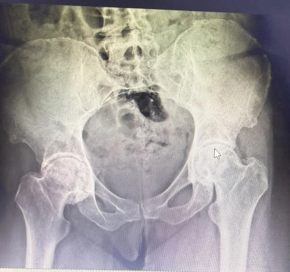 Radiografía de pelvis previa a la cirugía de reemplazo de cadera