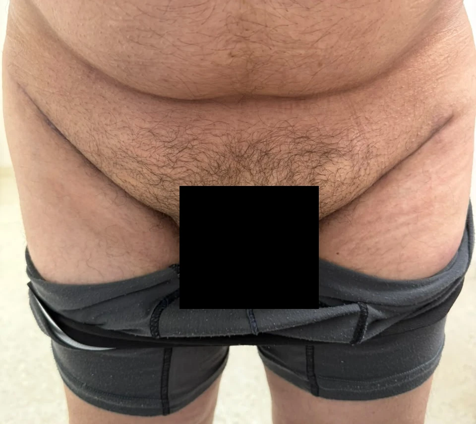 Las dos cicatrices ya curadas del reemplazo bilateral de cadera, siguiendo el pliegue inguinal de cada lado