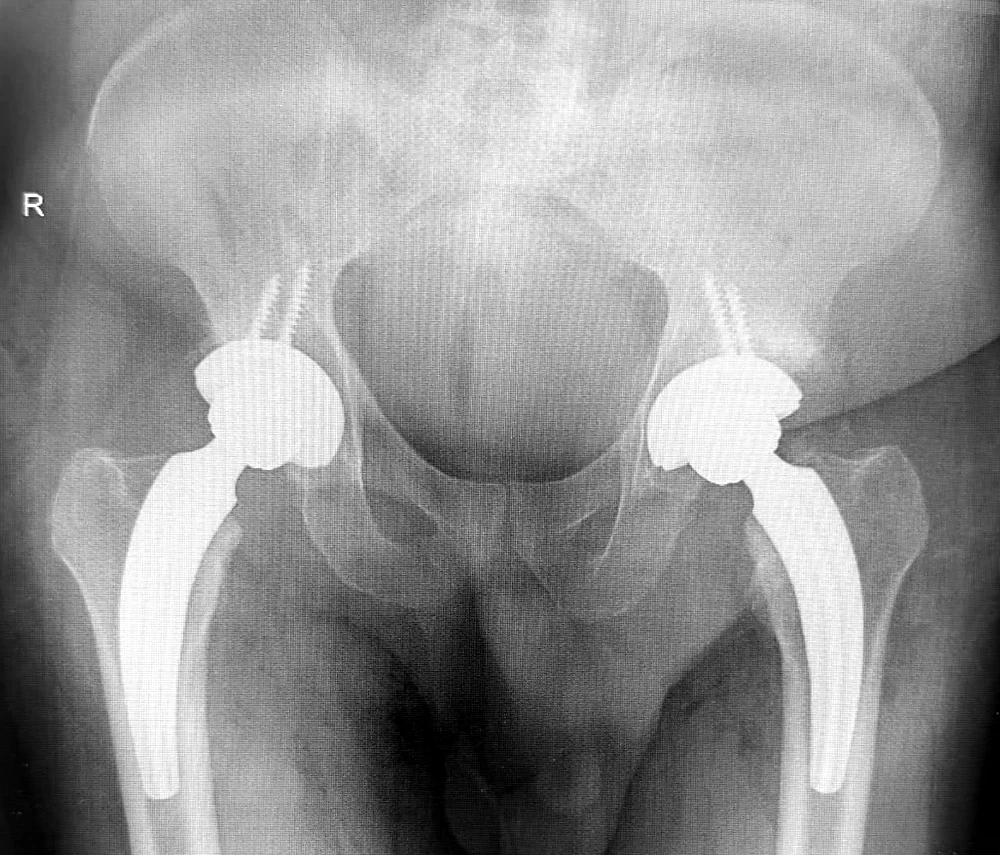 Radiografía posoperatoria con las dos prótesis de cadera implantadas por abordaje anterior bikini