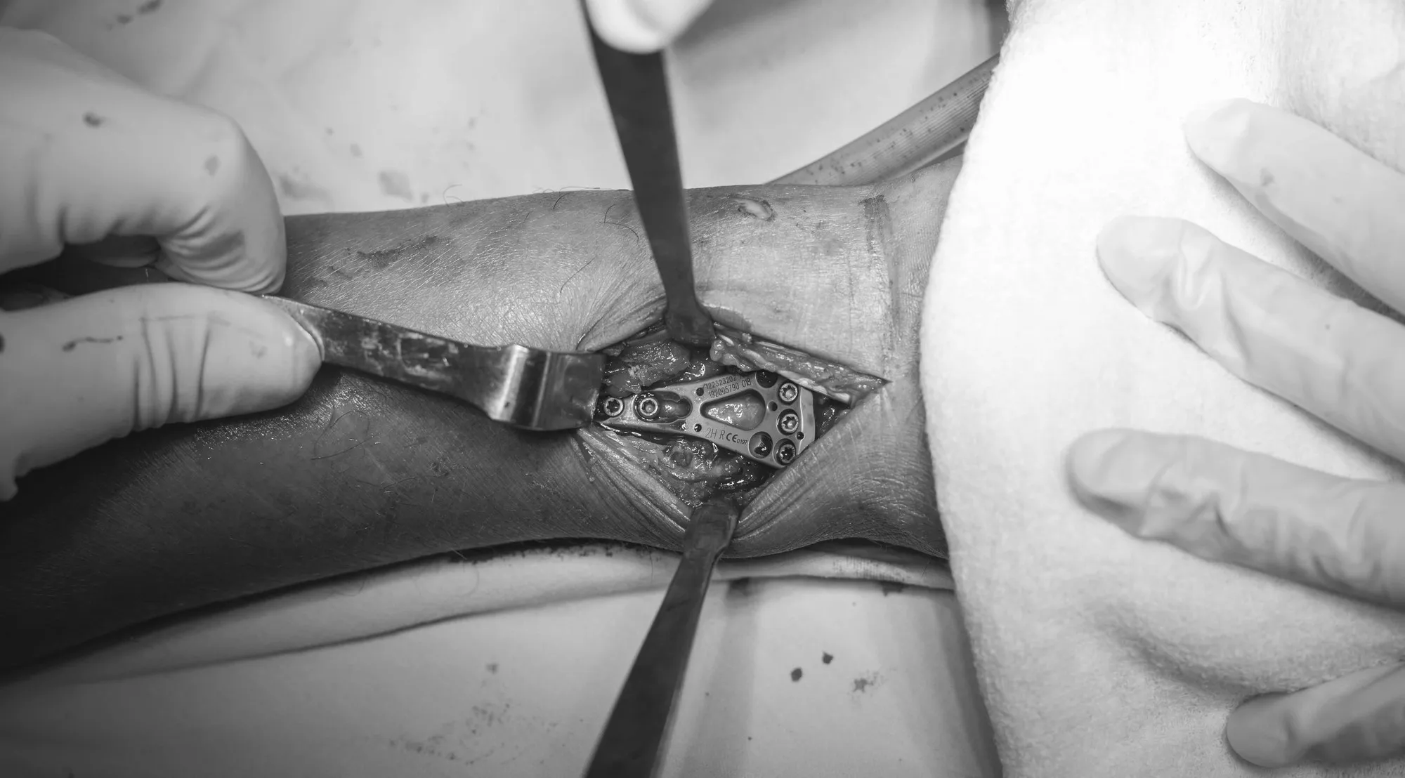 Vista intraoperatoria de placa de ángulo variable instalada en radio distal para fijación de fractura de muñeca