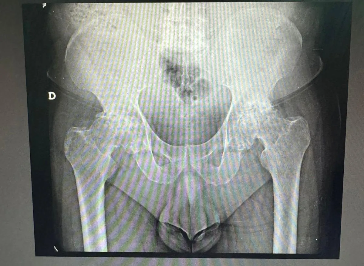 Radiografía de pelvis mostrando artrosis bilateral de cadera