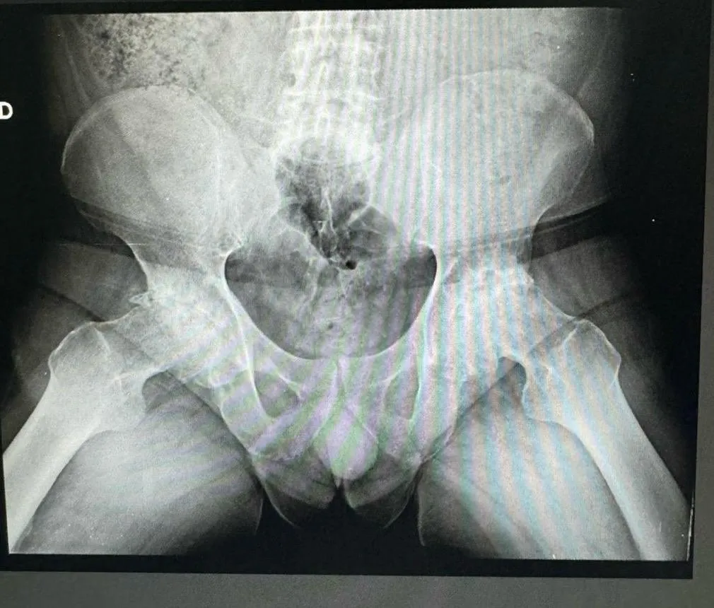 Radiografía preoperatoria de pelvis mostrando deformidad de cabezas femorales por artrosis bilateral