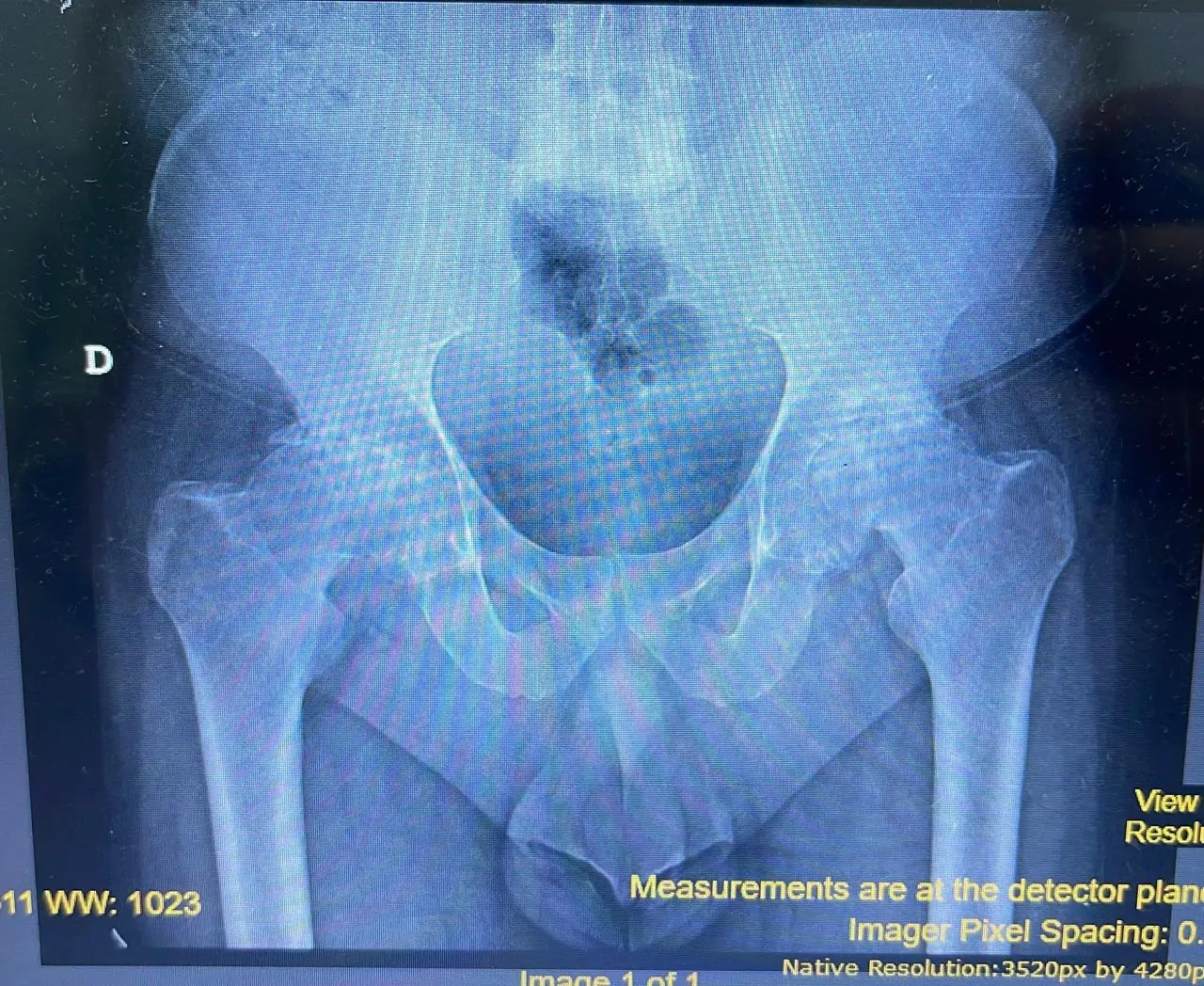 Radiografía digital preoperatoria de pelvis con mediciones para planificación quirúrgica