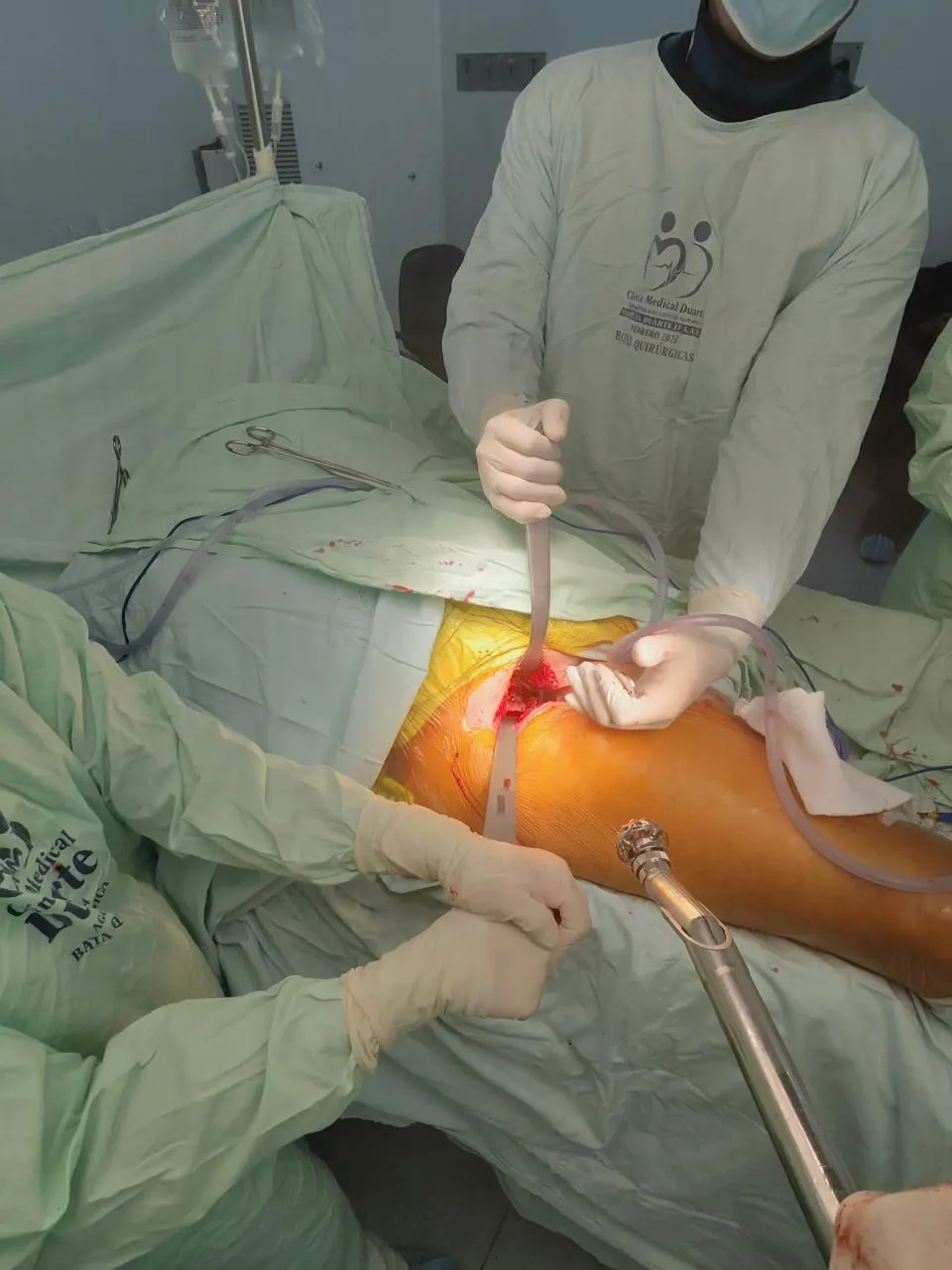 Vista intraoperatoria del abordaje anterior directo con sistema de drenaje durante reemplazo de cadera