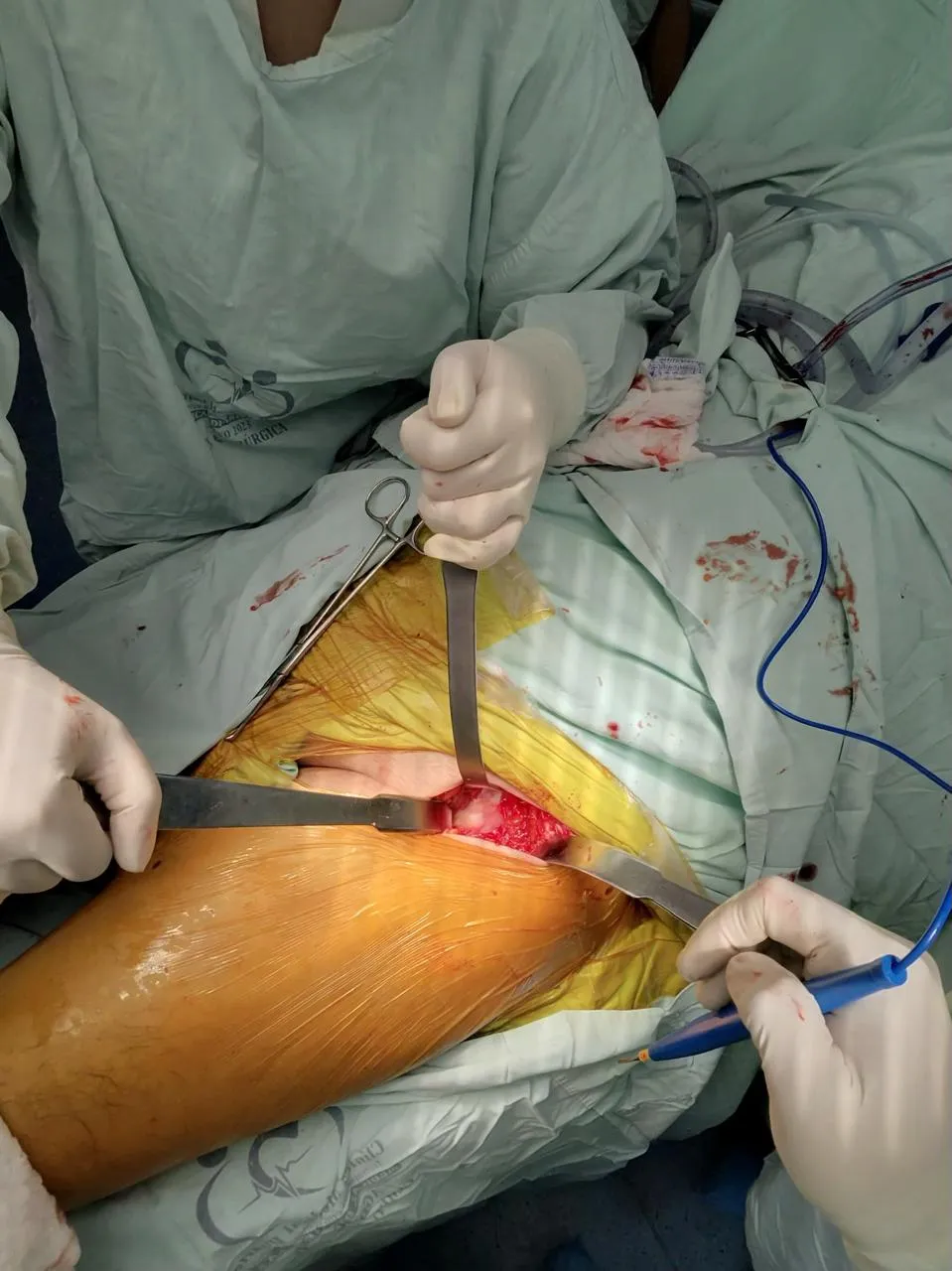 Vista intraoperatoria con retractores exponiendo la articulación de cadera durante el reemplazo